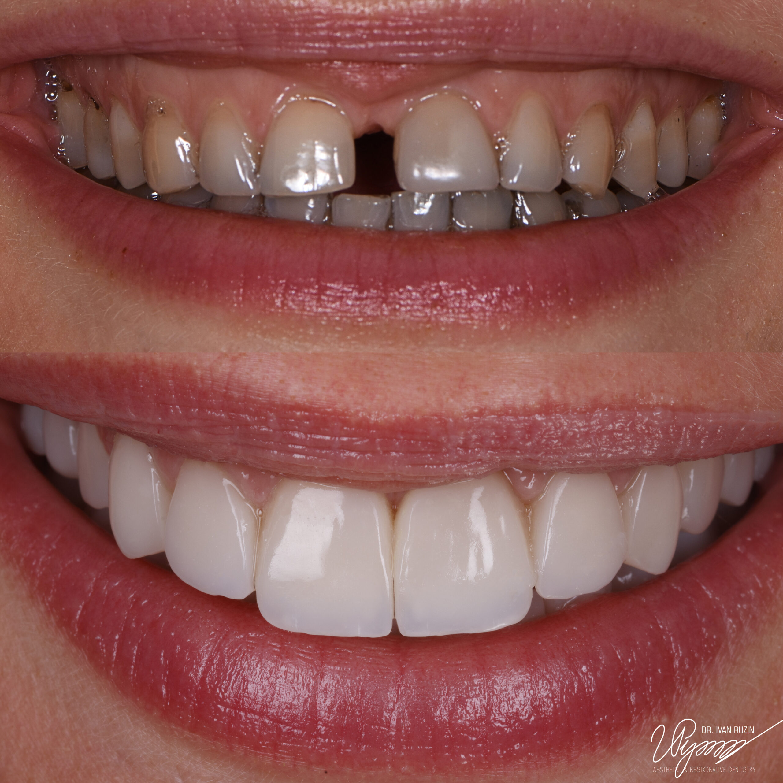 Close black triangles/diastema​