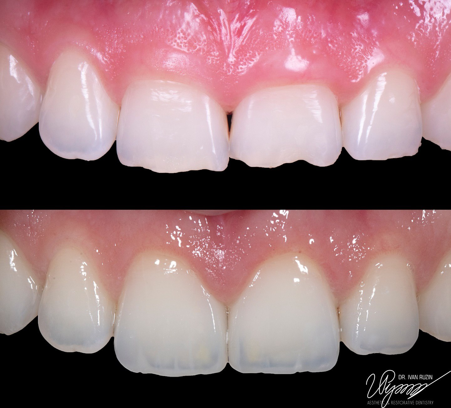 Restore Irregularly Shaped Teeth